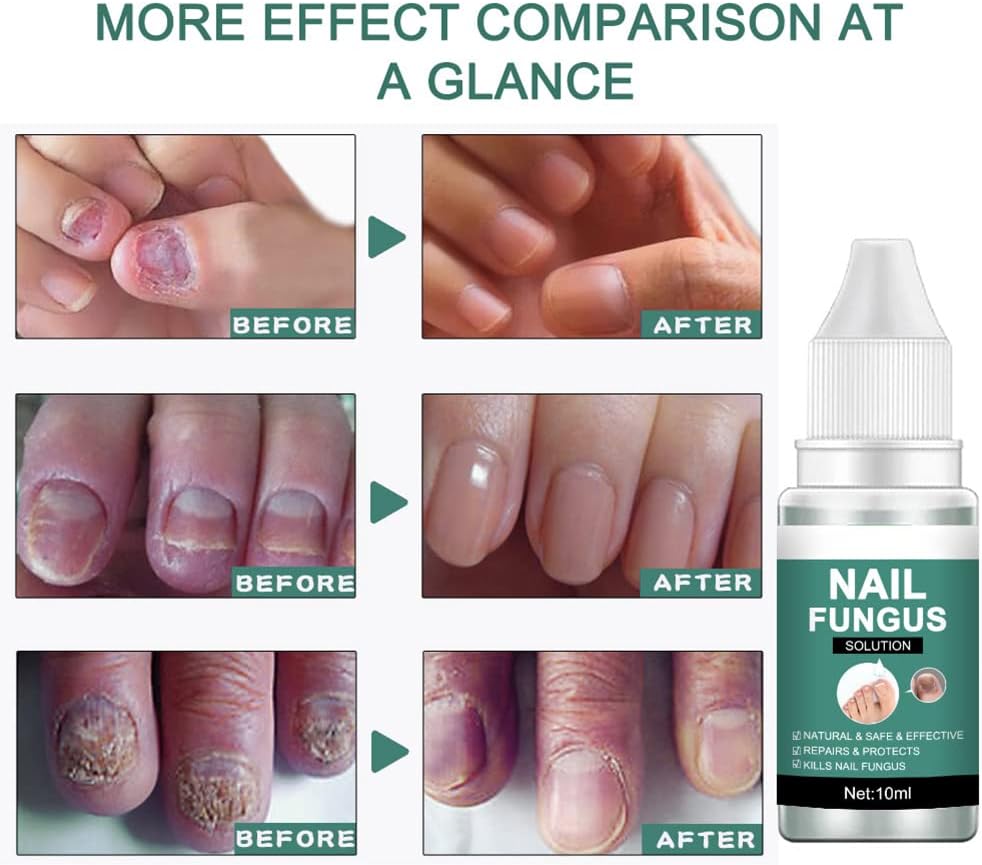 Nail fungus solution